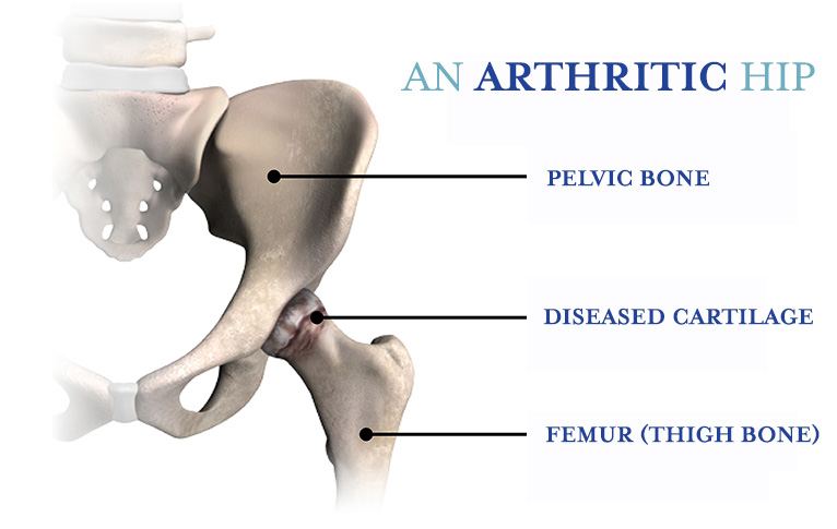 A diagram showing an arthritic hip