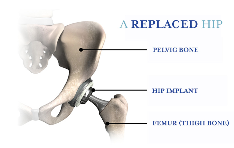 A diagram showing a replaced hip