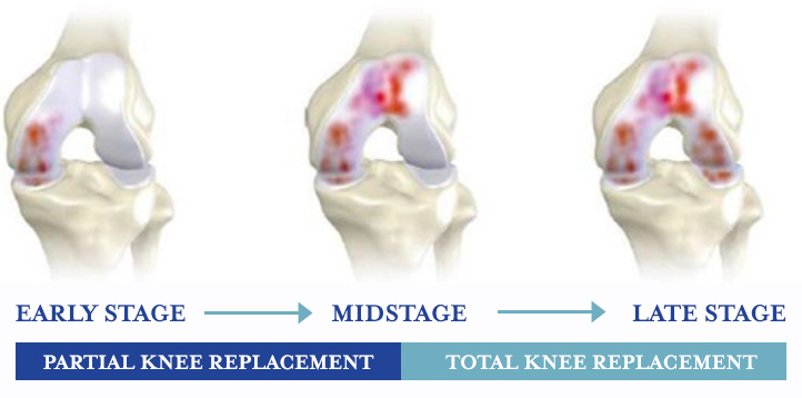 The different stages of knee health for knee replacement surgery