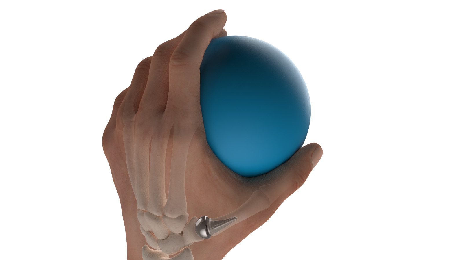 BioPro® Modular Thumb Implant (Thumb & Hand Joint Replacement)